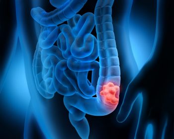 Cancerul de colon a crescut în rândul tinerilor – informatii și statistici