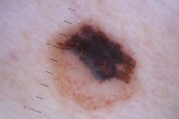 Peptida Rb4, rezultate promiţătoare în tratamentul melanomului