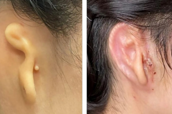 Primul transplant al unei urechi 3D, realizate cu celule umane