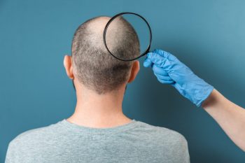 Alopecia cicatriceală, tipuri și tratament