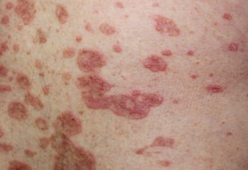 Lichenul plan cutanat și erupțiile lichenoide postmedicamentoase