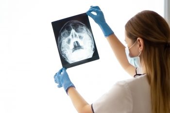 Fracturile de maxilar, clasificare și diagnostic