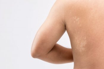 Ce este pitiriazisul versicolor și cum apare: simptome, cauze și diagnostic