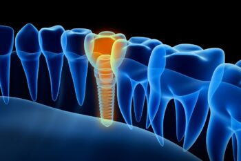 Implantul dentar – analize, intervenții premergătoare și tipuri de implanturi