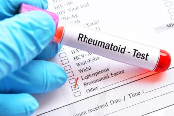 Factor reumatoid (FR) – valori normale, afecțiuni asociate valorilor crescute