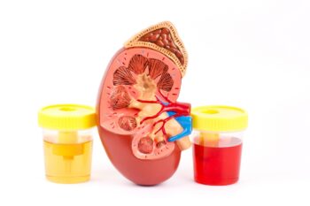 Hematurie (sânge în urină) – factori de risc, cauze și afecțiuni asociate