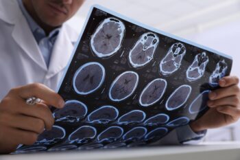 Tratament cu celule stem în scleroza multiplă? Ce arată un studiu derulat pe doi ani