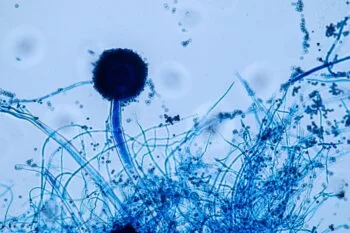 Aspergiloza pulmonară, diagnostic şi opţiuni de tratament