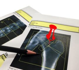 tratament osteoporoza