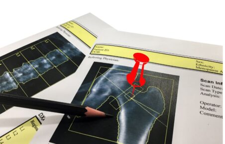 tratament osteoporoza