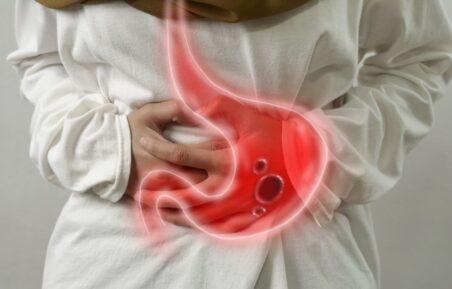 ulcer gastric