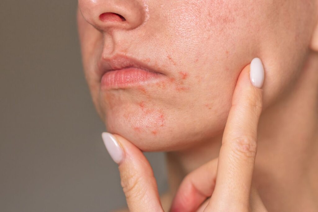 dermatita periorala manifestari