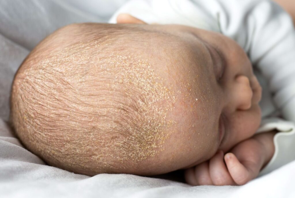 dermatita