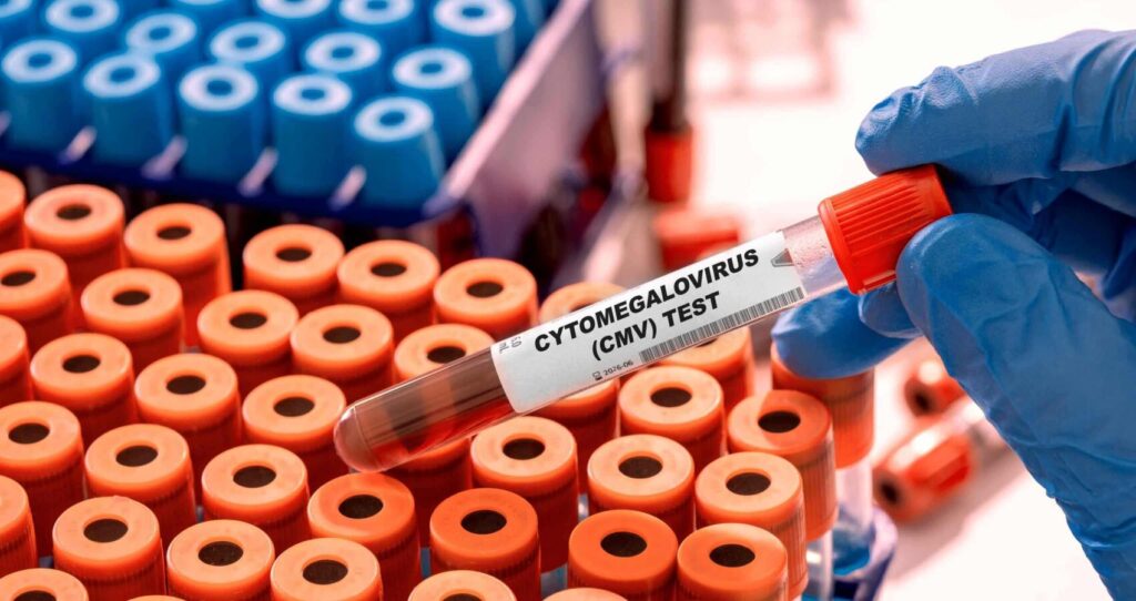 infectie citomegalovirus